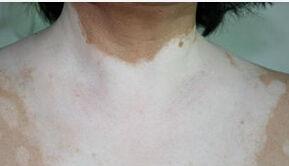 白癜风可以吃凌瓜吗,白癜风患者适宜食用凌瓜的探讨